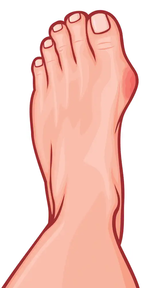 Chiropody For Bunions