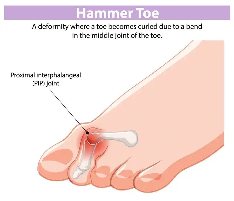 Chiropody For Hammer Toes